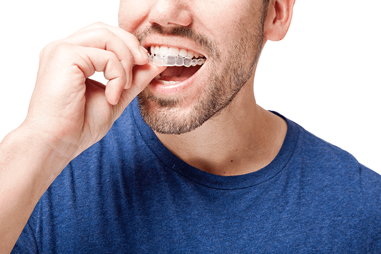 man inserting invisalign aligners on his teeth