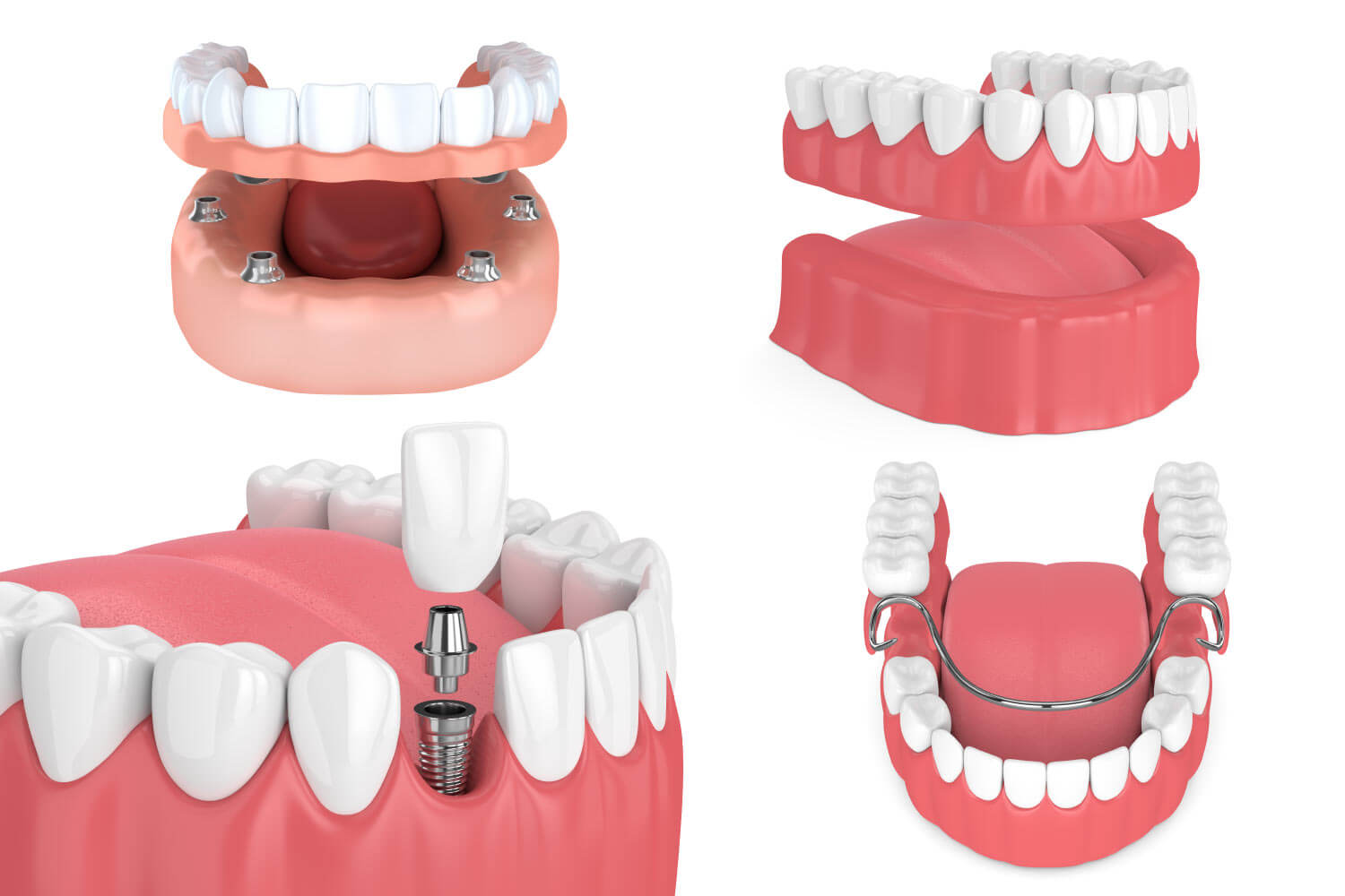 Dental implants vs. dentures as tooth replacement options in Wolcott, CT