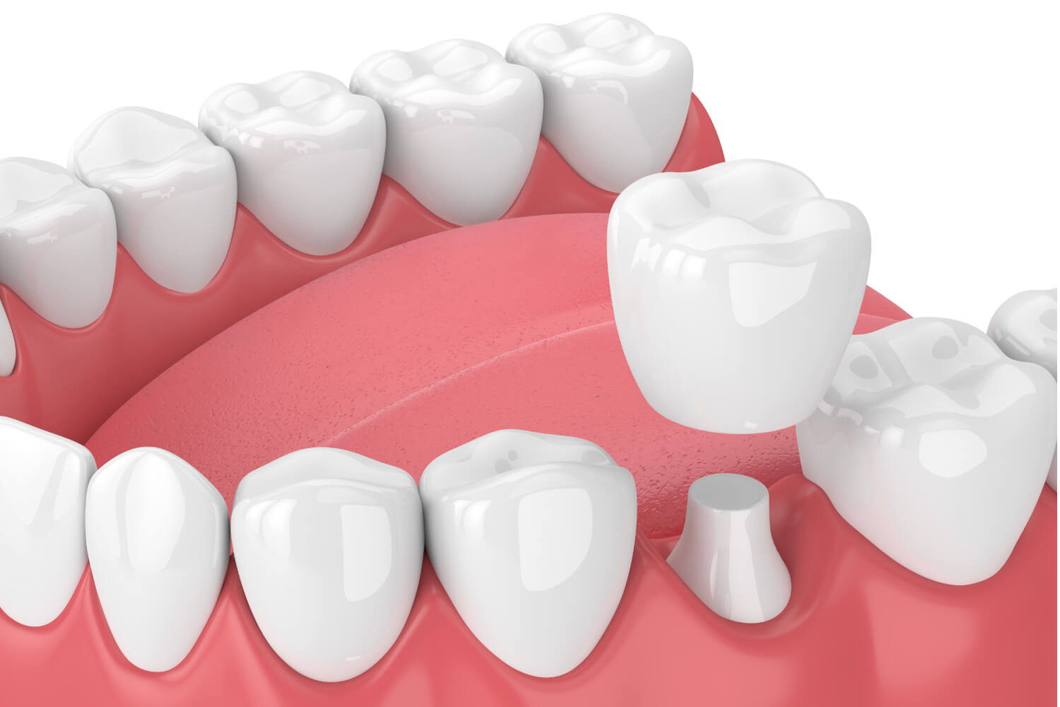 A dental crown caps a molar in a drawing