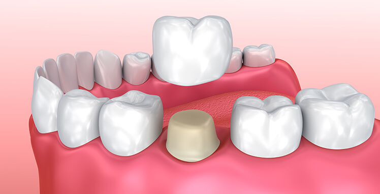 illustration of a dental crown