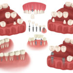 Different configurations of dental implants & bridges