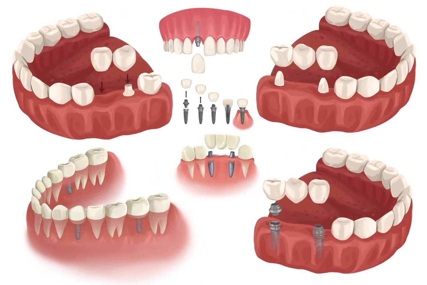 Different configurations of dental implants & bridges