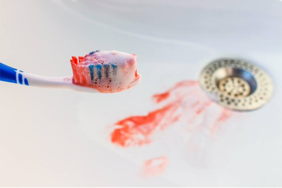 A toothbrush with bloody bristles and blood in the sink from bleeding gums because of gum disease