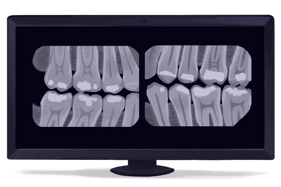 Illustration of teeth on a dental X-ray image