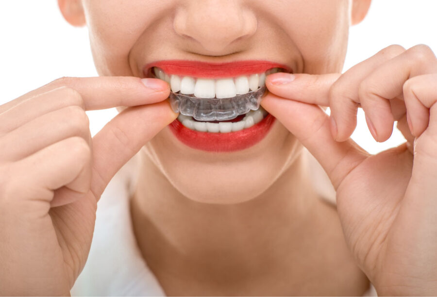 Closeup of woman with red lipstick putting on clear Invisalign aligners