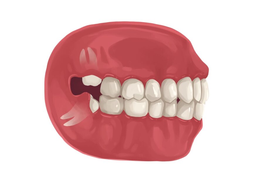 Illustration of an impacted wisdom tooth that needs to be removed