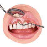 Illustration of scaling and root planing during a deep dental cleaning
