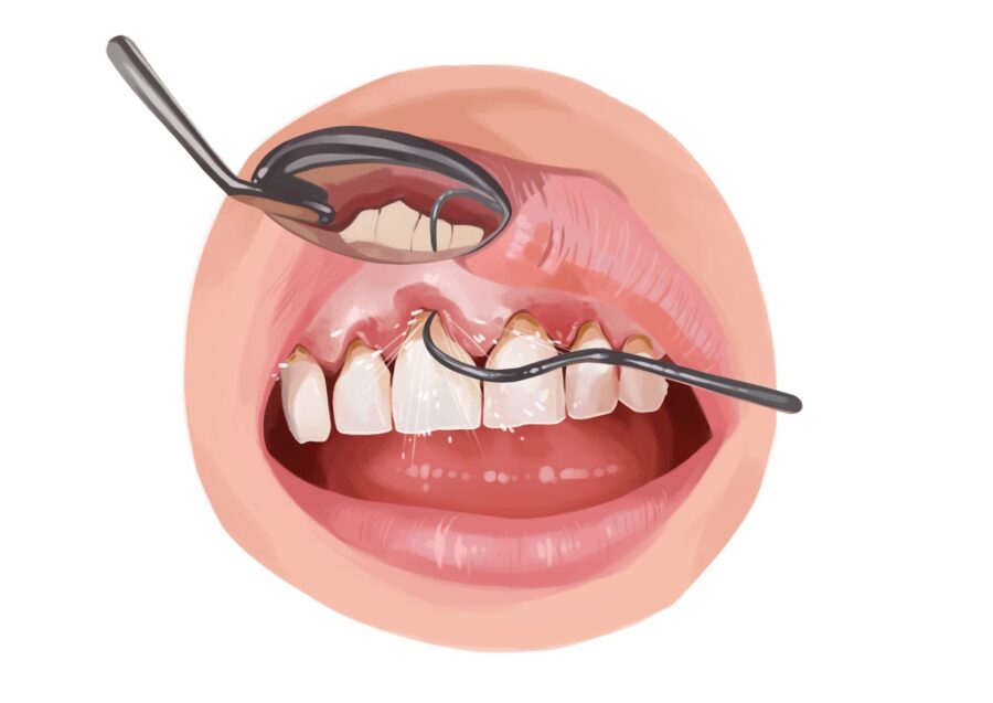 Illustration of scaling and root planing during a deep dental cleaning