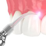 laser dentistry, dental laser