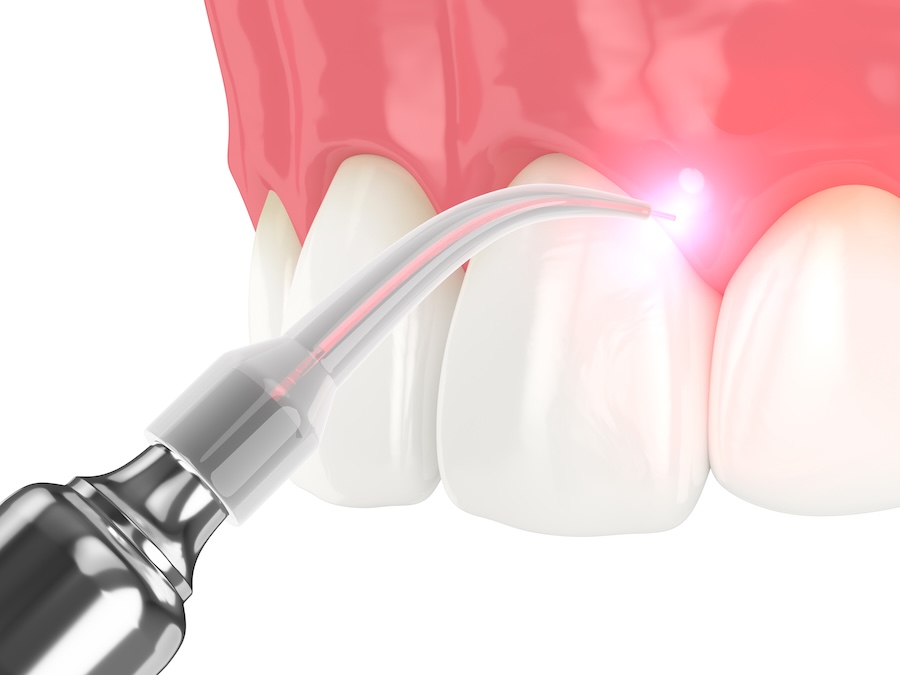 laser dentistry, dental laser
